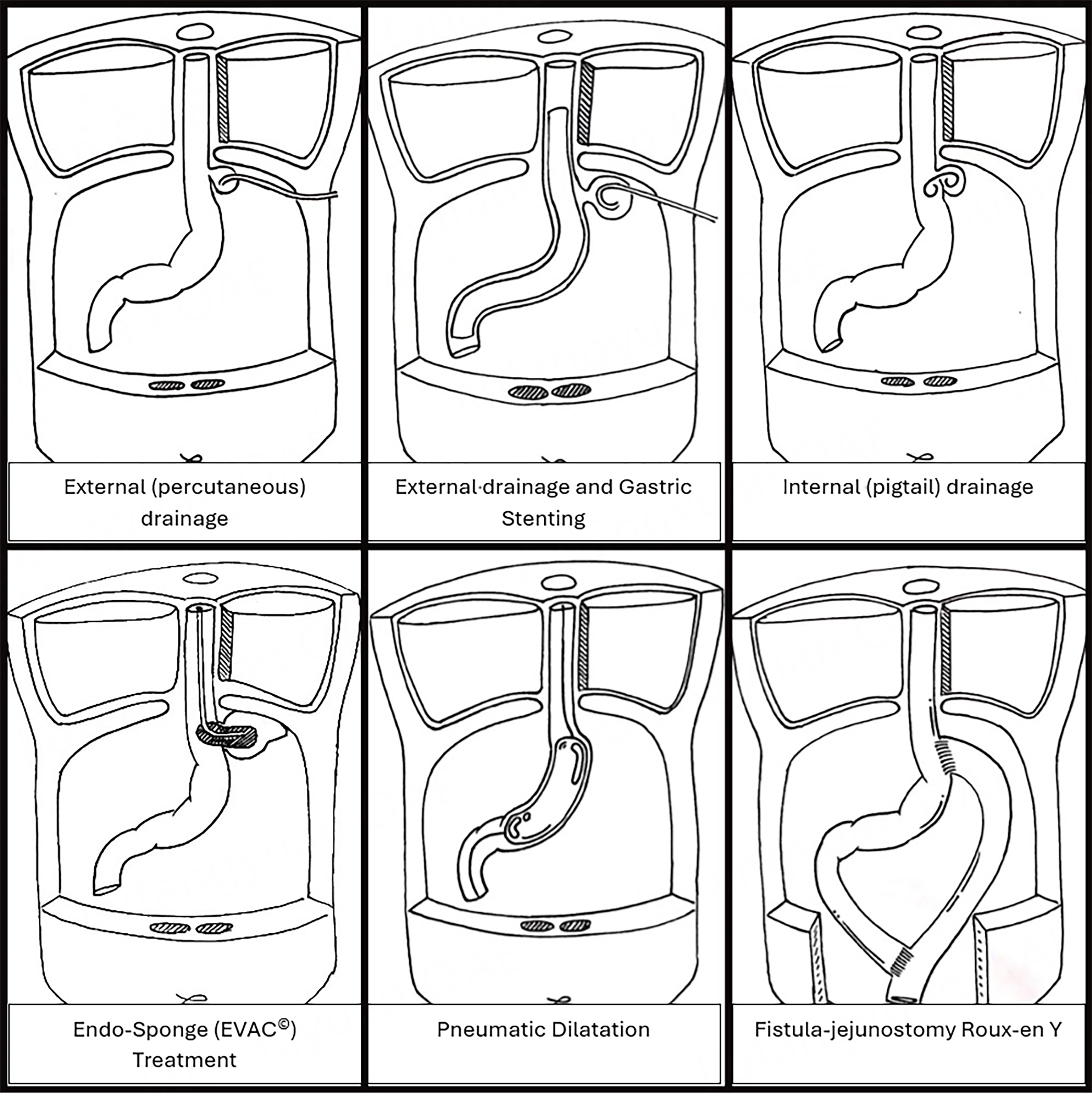 Stage dependent management of sleeve gastrectomy leaks - a systematic review with proposed classification and management algorithm