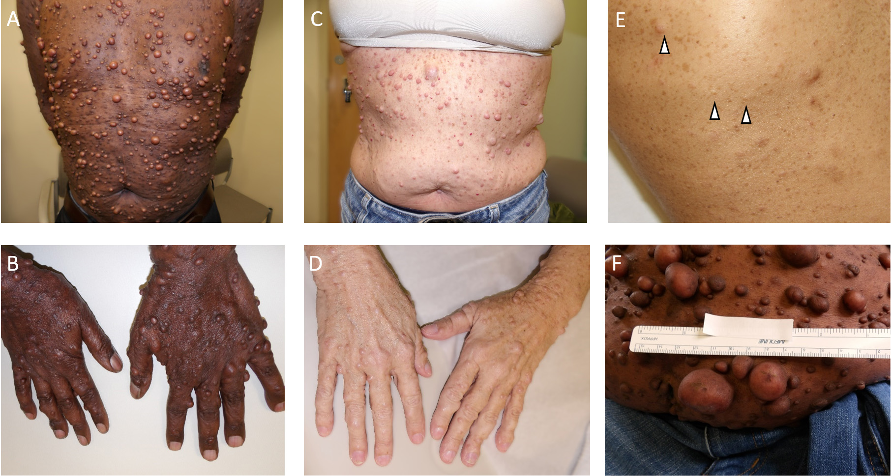 The clinical landscape of cutaneous neurofibromas in neurofibromatosis type 1