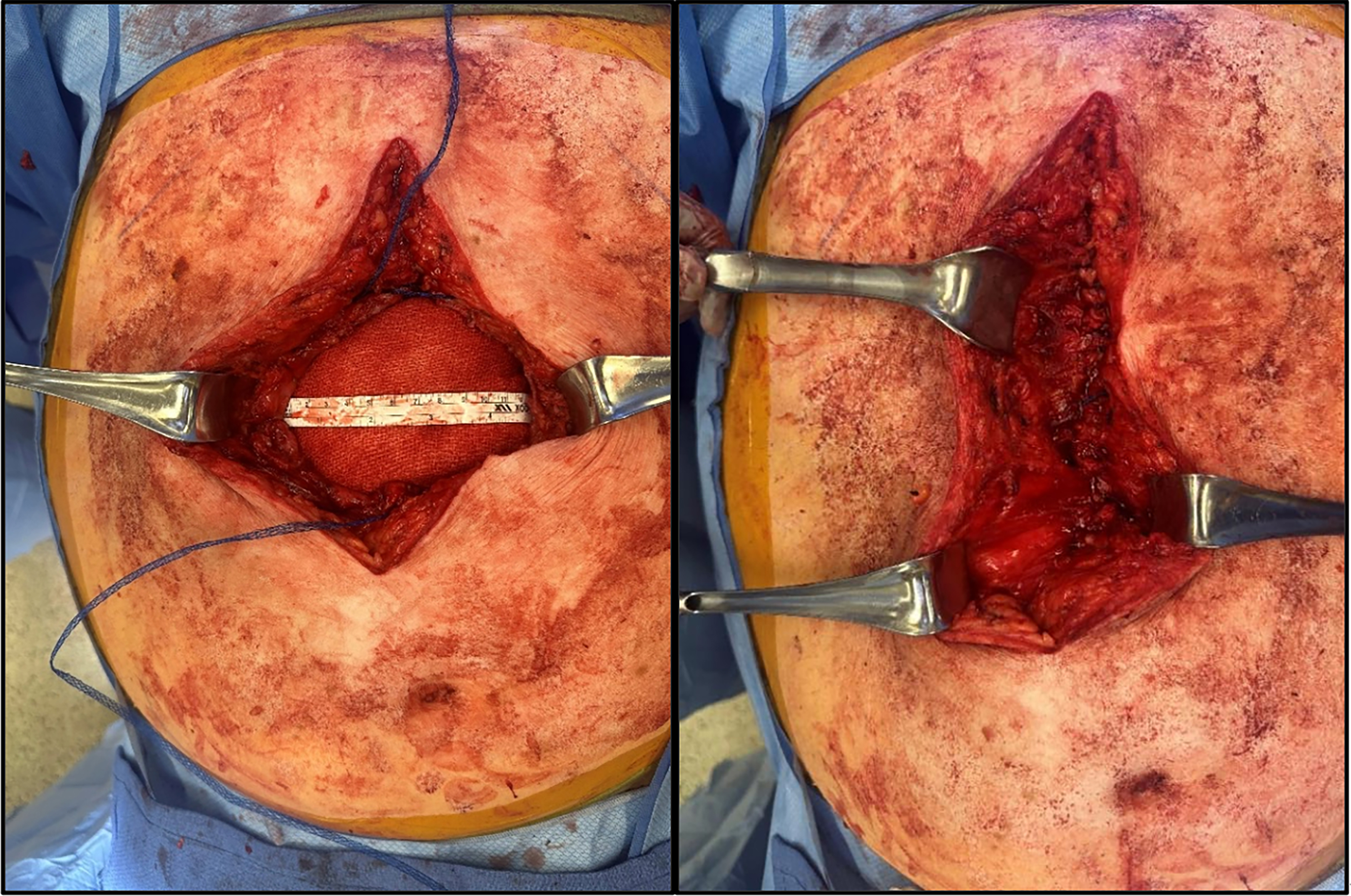 Contemporary approaches to complex and contaminated hernias: innovations in mesh technology