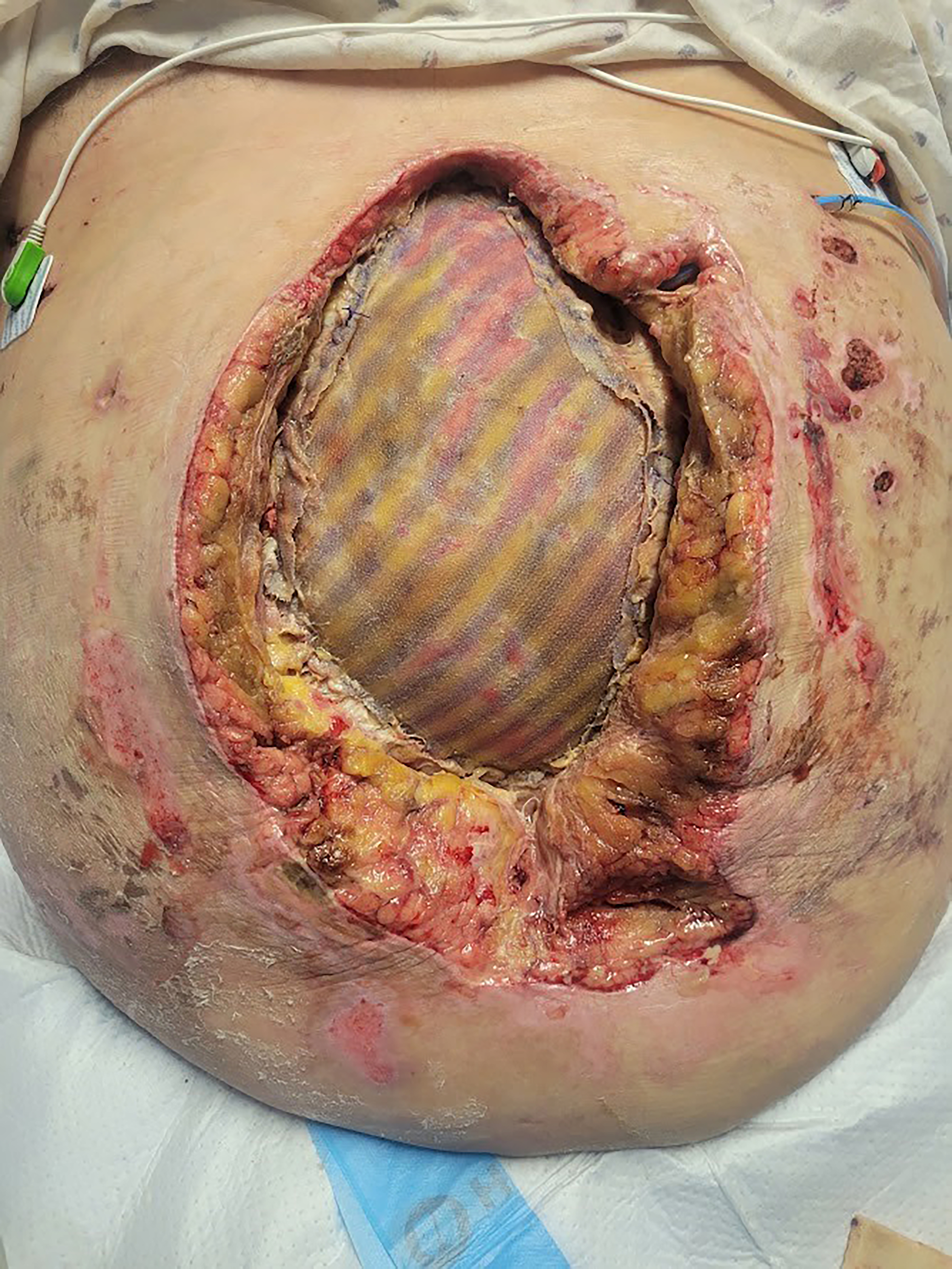Contemporary approaches to complex and contaminated hernias: innovations in mesh technology