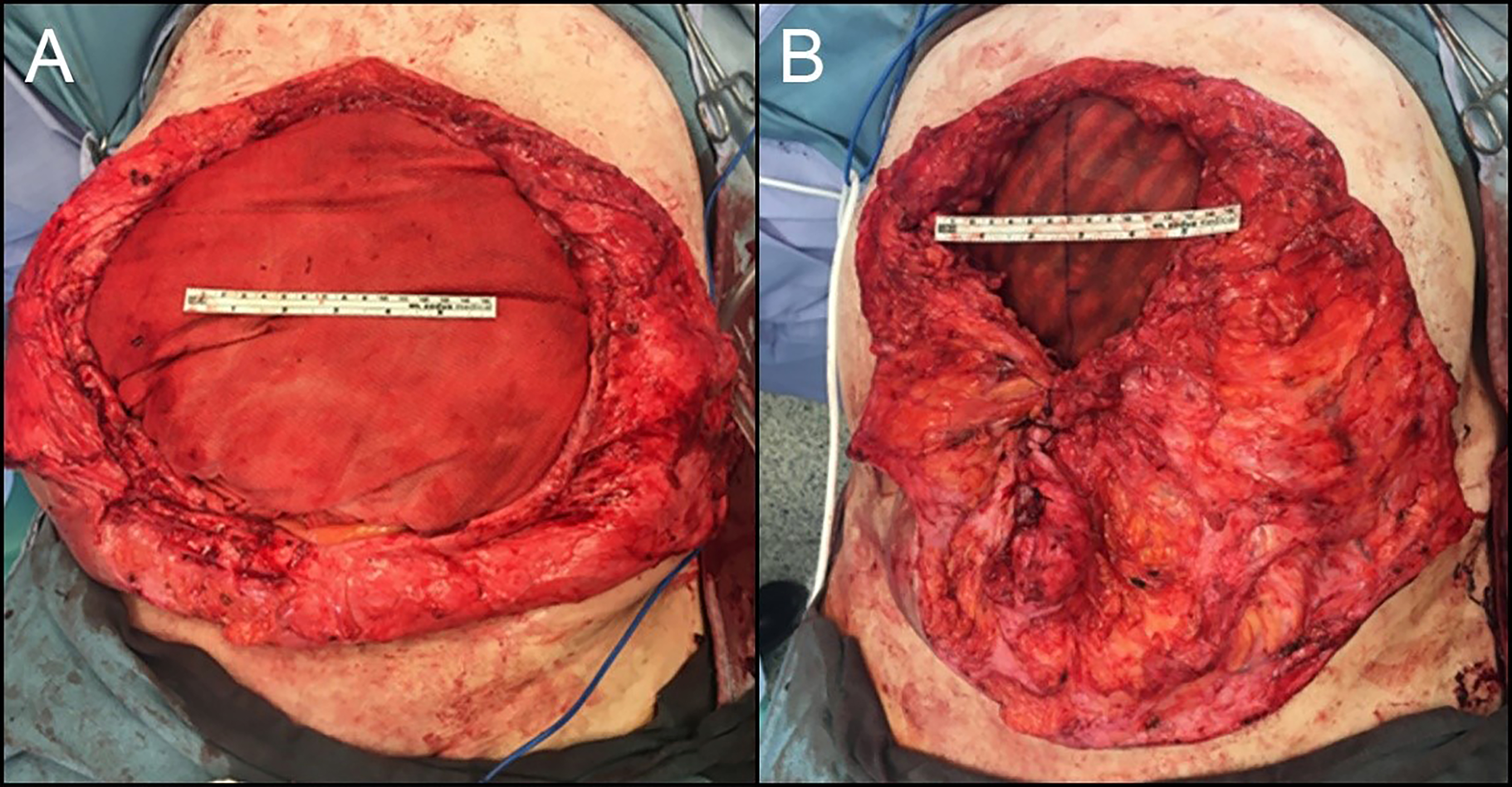 Contemporary approaches to complex and contaminated hernias: innovations in mesh technology