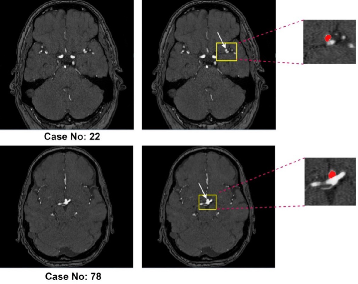 Intracranial aneurysm segmentation with nnU-net: utilizing loss functions and automated vessel extraction