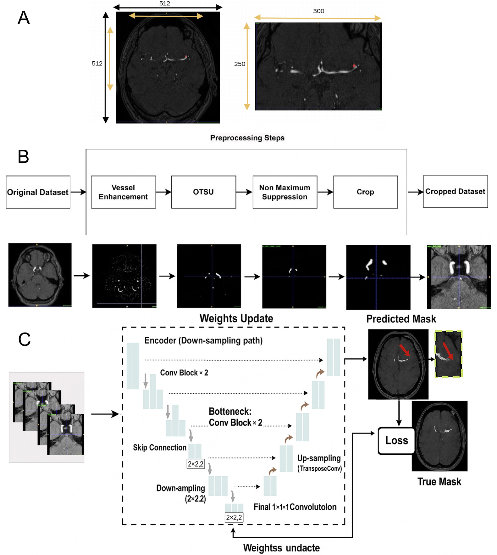 Intracranial aneurysm segmentation with nnU-net: utilizing loss functions and automated vessel extraction