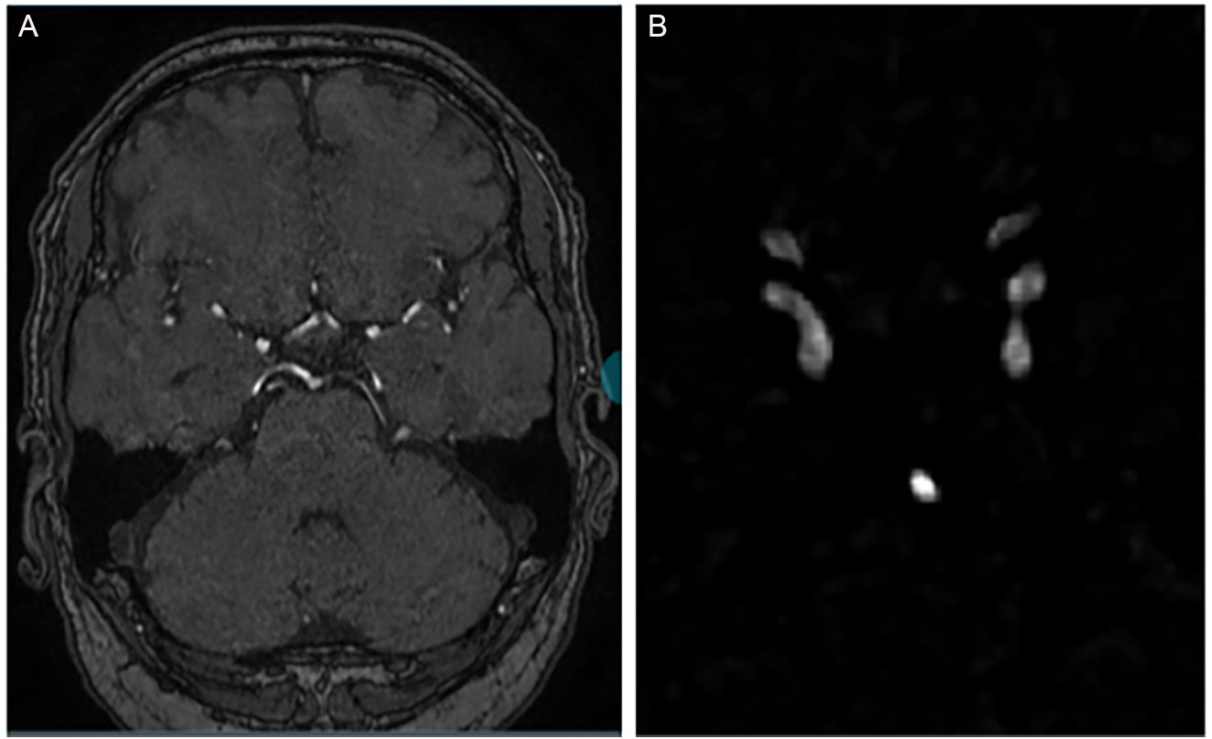 Intracranial aneurysm segmentation with nnU-net: utilizing loss functions and automated vessel extraction