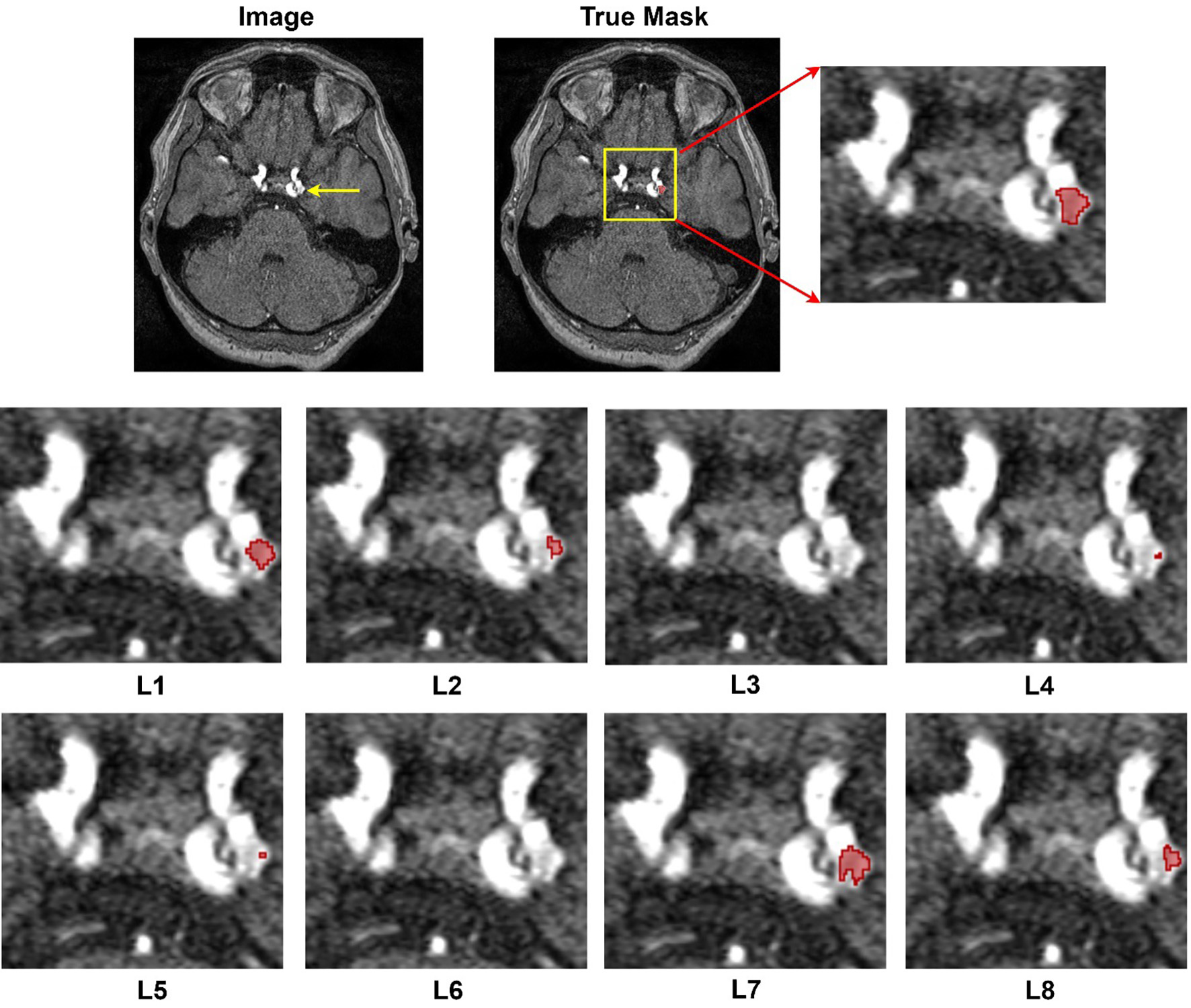 Intracranial aneurysm segmentation with nnU-net: utilizing loss functions and automated vessel extraction