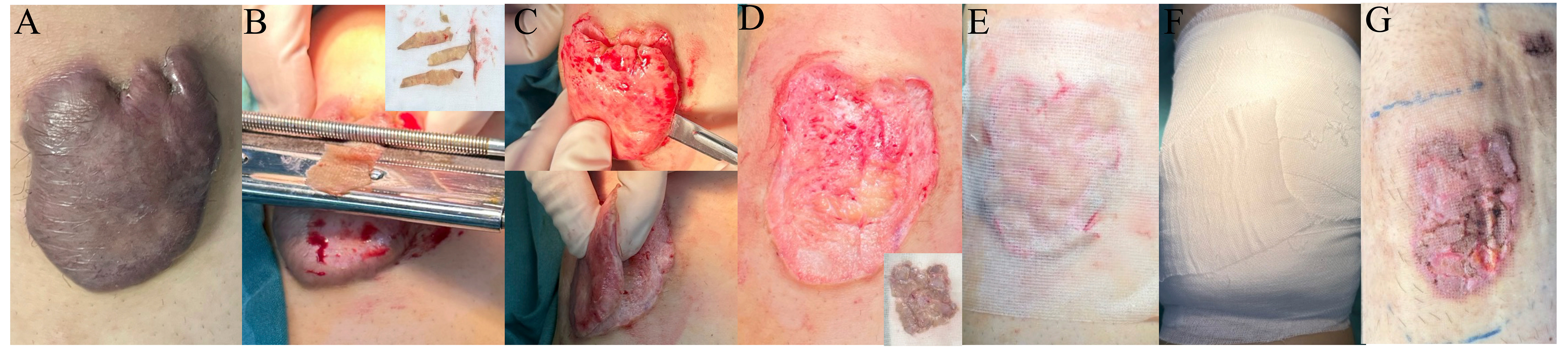 Retrospective analysis of keloid split-thickness skin graft replantation combined with LCR therapy for keloid treatment