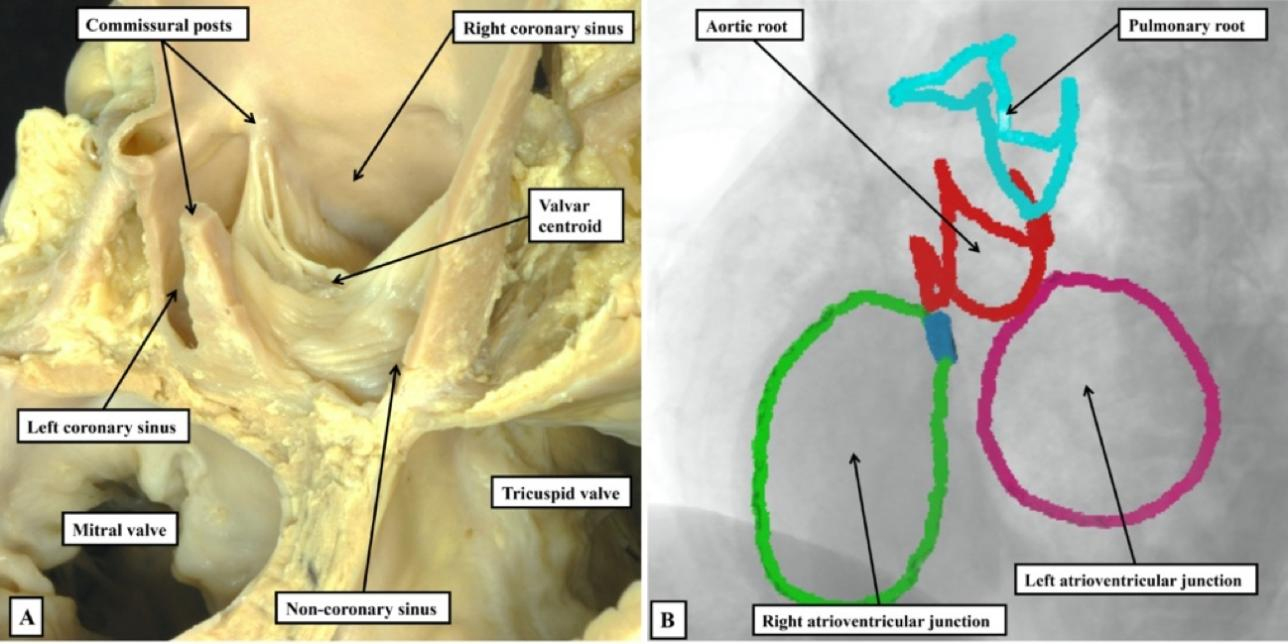 The need for precision when describing the aortic root