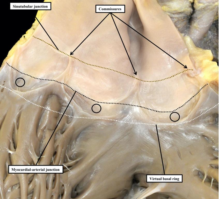 The need for precision when describing the aortic root