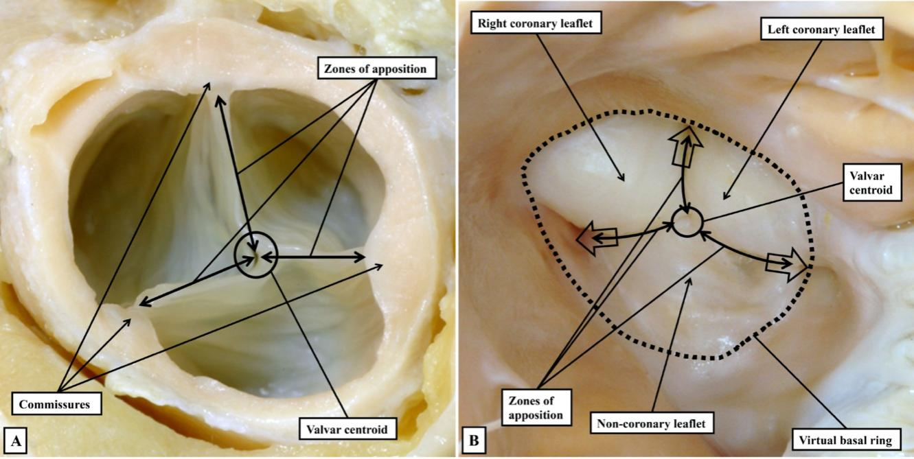 The need for precision when describing the aortic root