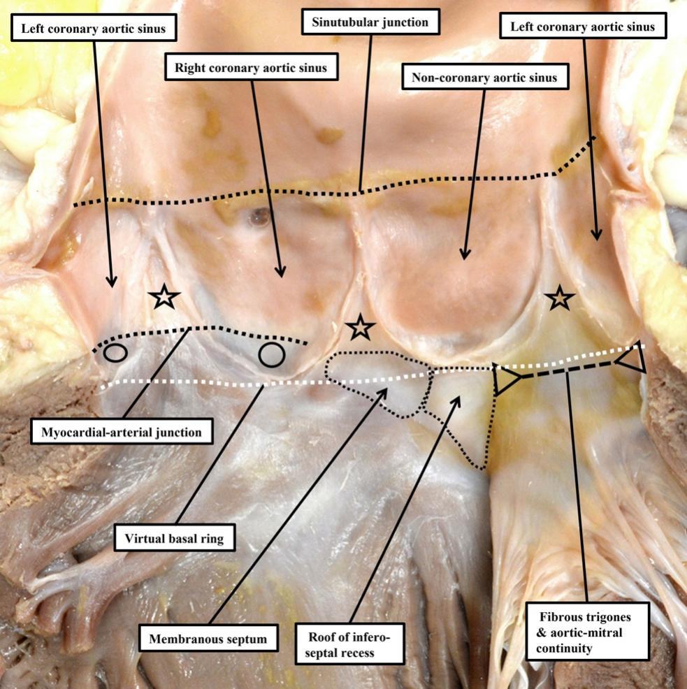 The need for precision when describing the aortic root