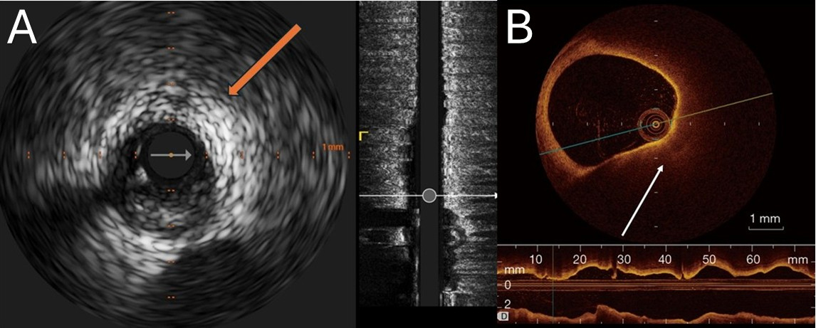 Artificial intelligence in coronary plaque characterization and risk assessment: from images to impact