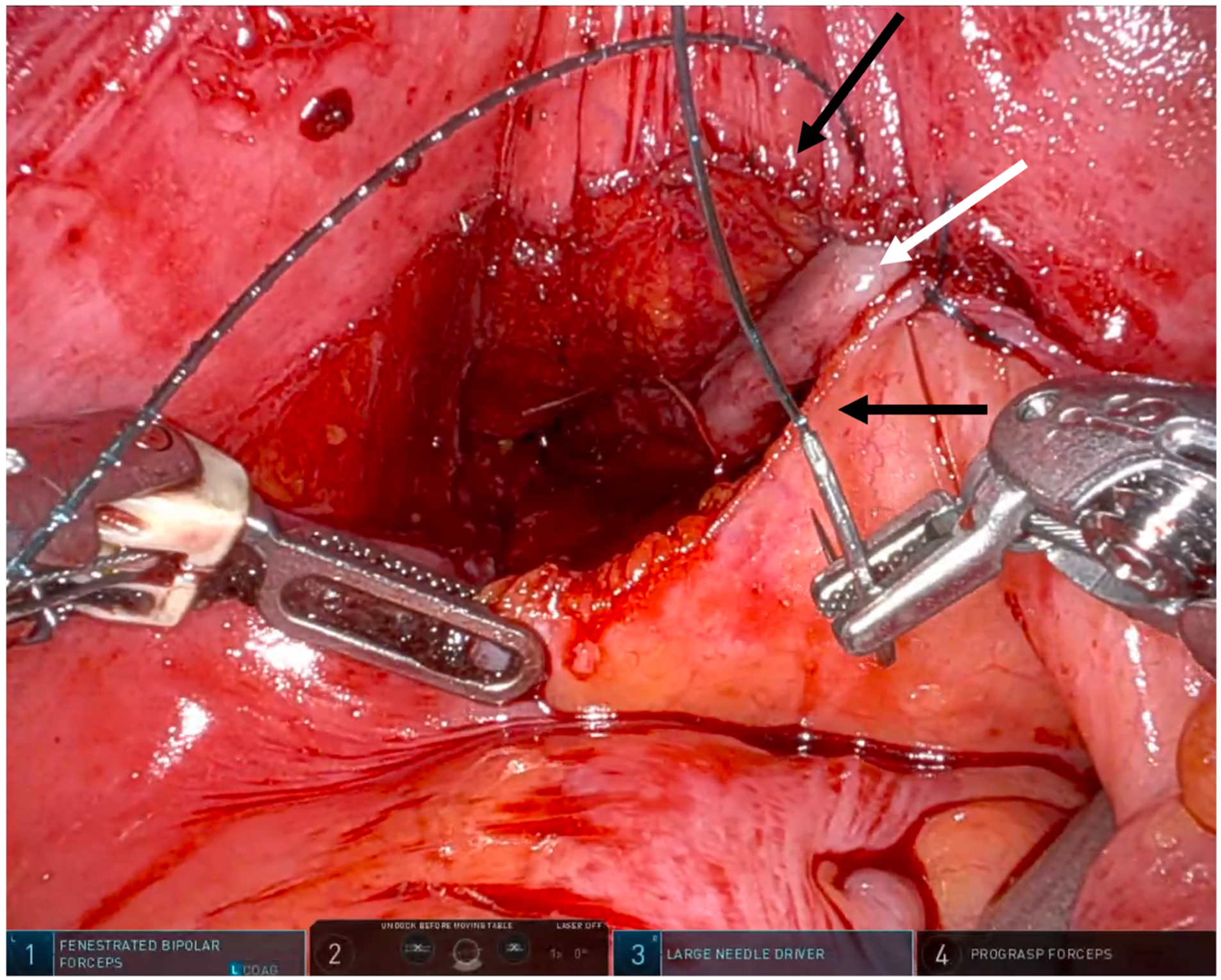 Technical considerations for neovaginal canal creation during primary and revision gender-affirming vaginoplasty
