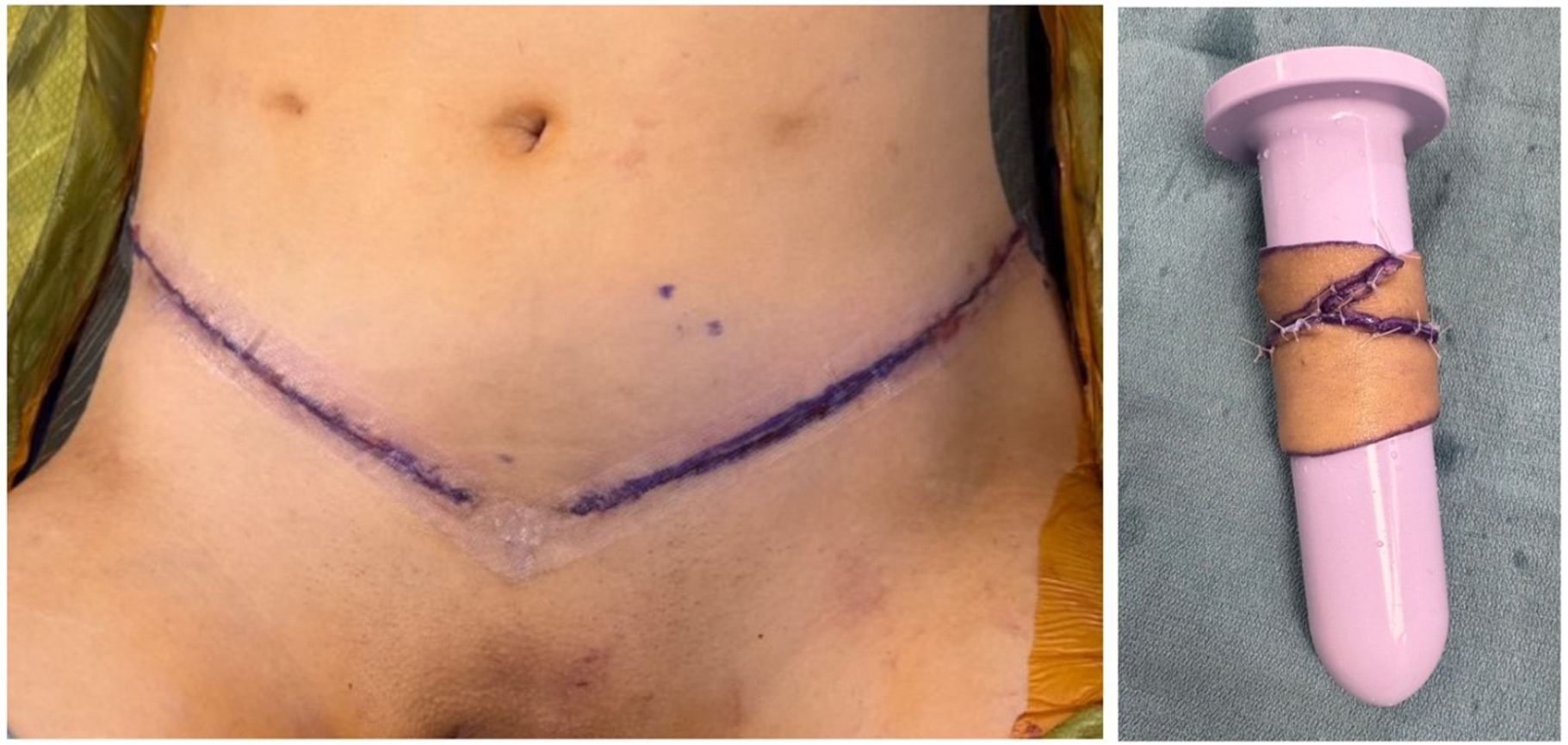 Technical considerations for neovaginal canal creation during primary and revision gender-affirming vaginoplasty