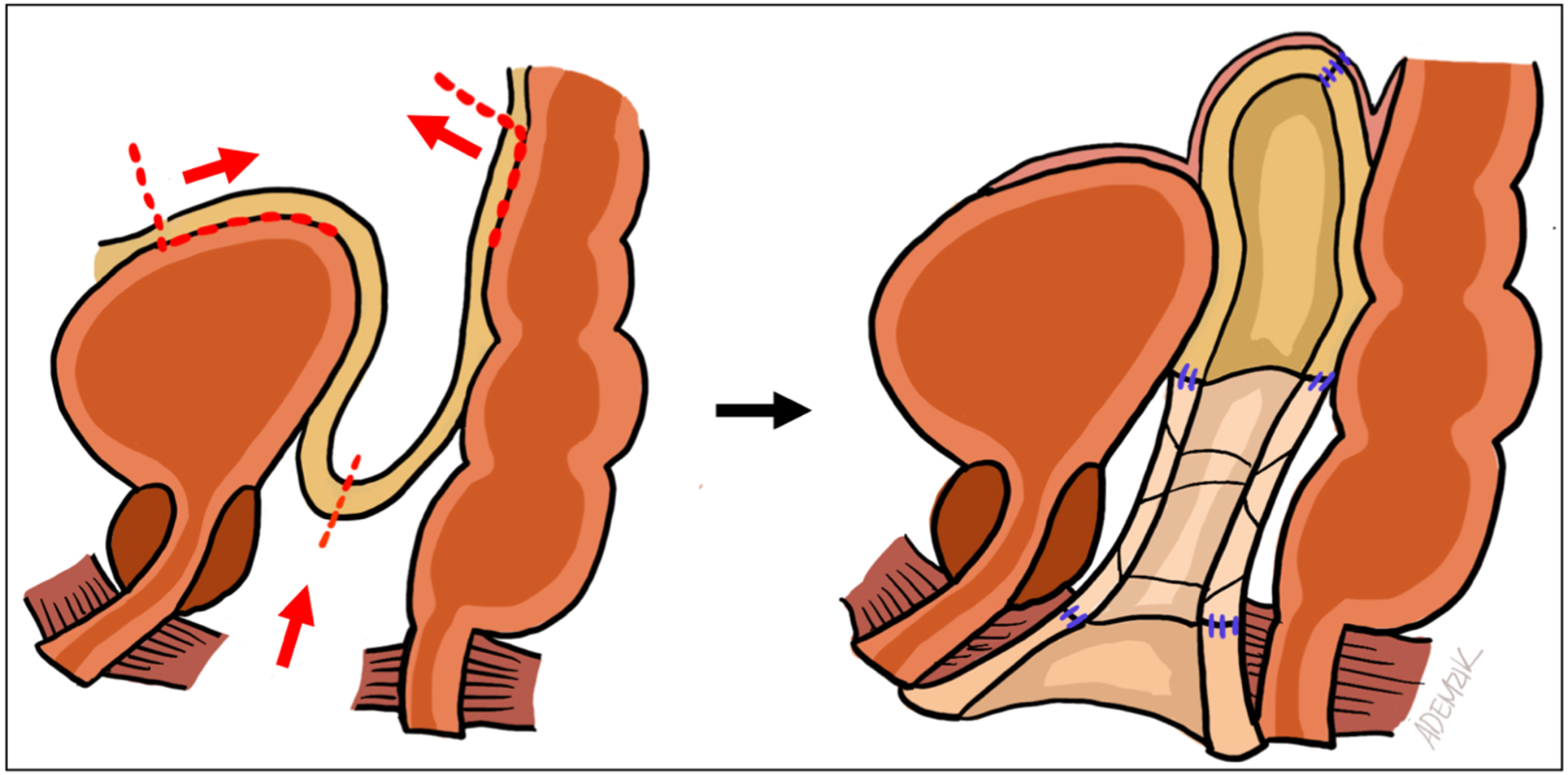 Technical considerations for neovaginal canal creation during primary and revision gender-affirming vaginoplasty