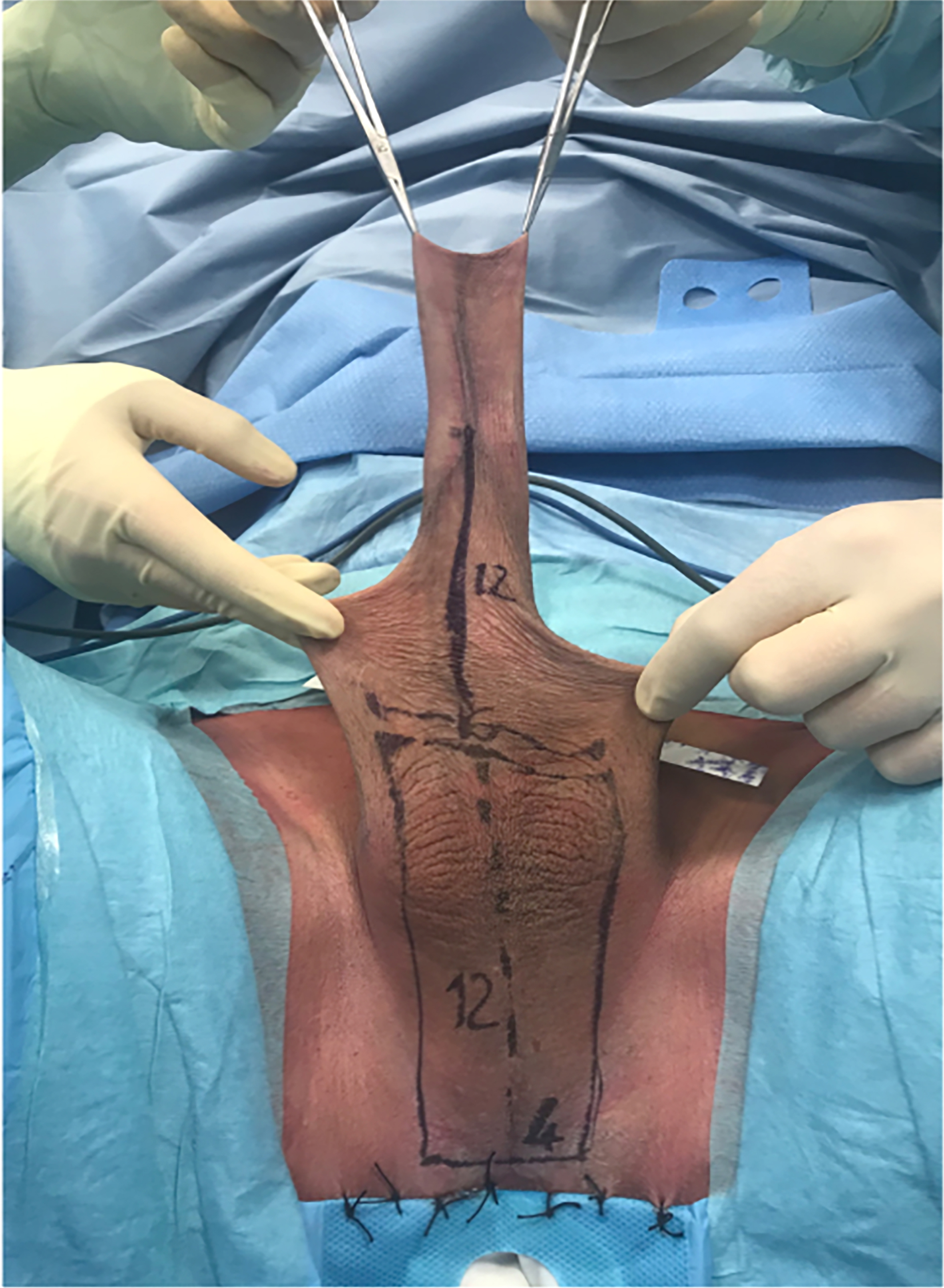 Surgical and functional outcomes of penoscrotal vaginoplasty in AMAB transgender patients: a comprehensive analysis of patient satisfaction and postoperative findings
