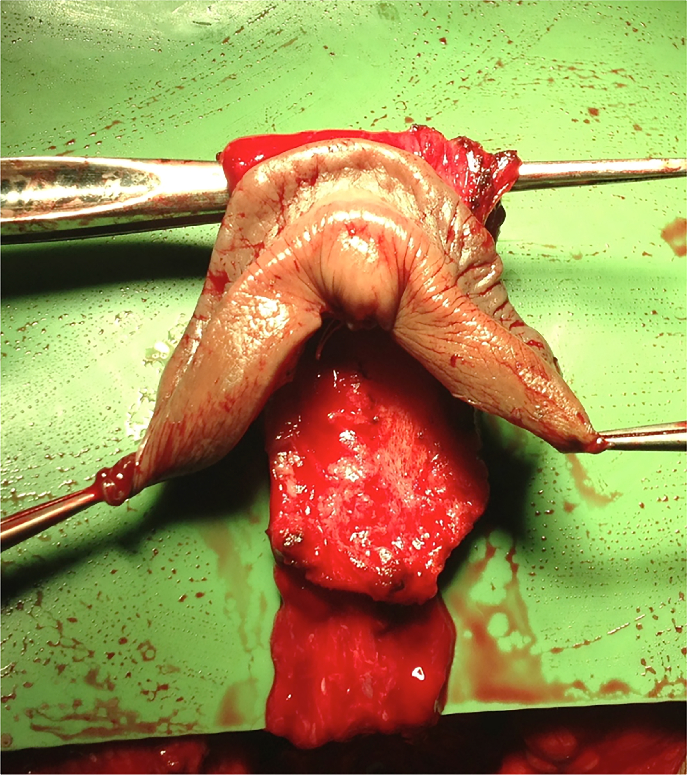 Surgical and functional outcomes of penoscrotal vaginoplasty in AMAB transgender patients: a comprehensive analysis of patient satisfaction and postoperative findings