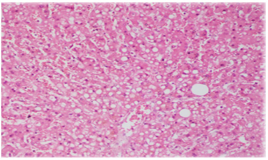 Histopathological characteristics in livers of deceased patients with COVID-19