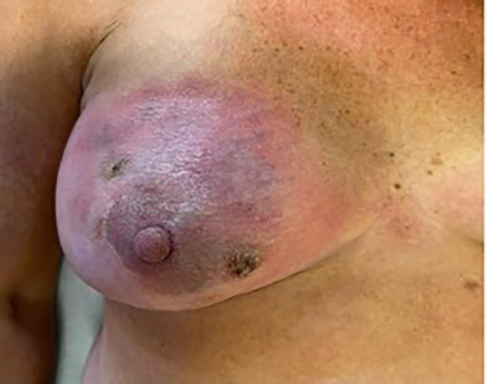 Implant salvage in post-mastectomy reconstruction complicated with infection: molecular diagnosis and negative-pressure wound therapy combined with expander