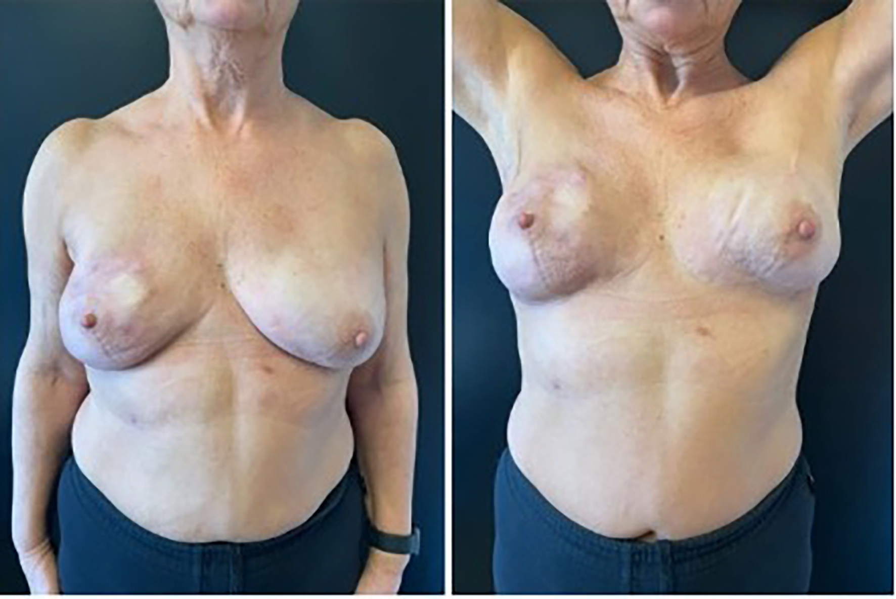 Implant salvage in post-mastectomy reconstruction complicated with infection: molecular diagnosis and negative-pressure wound therapy combined with expander
