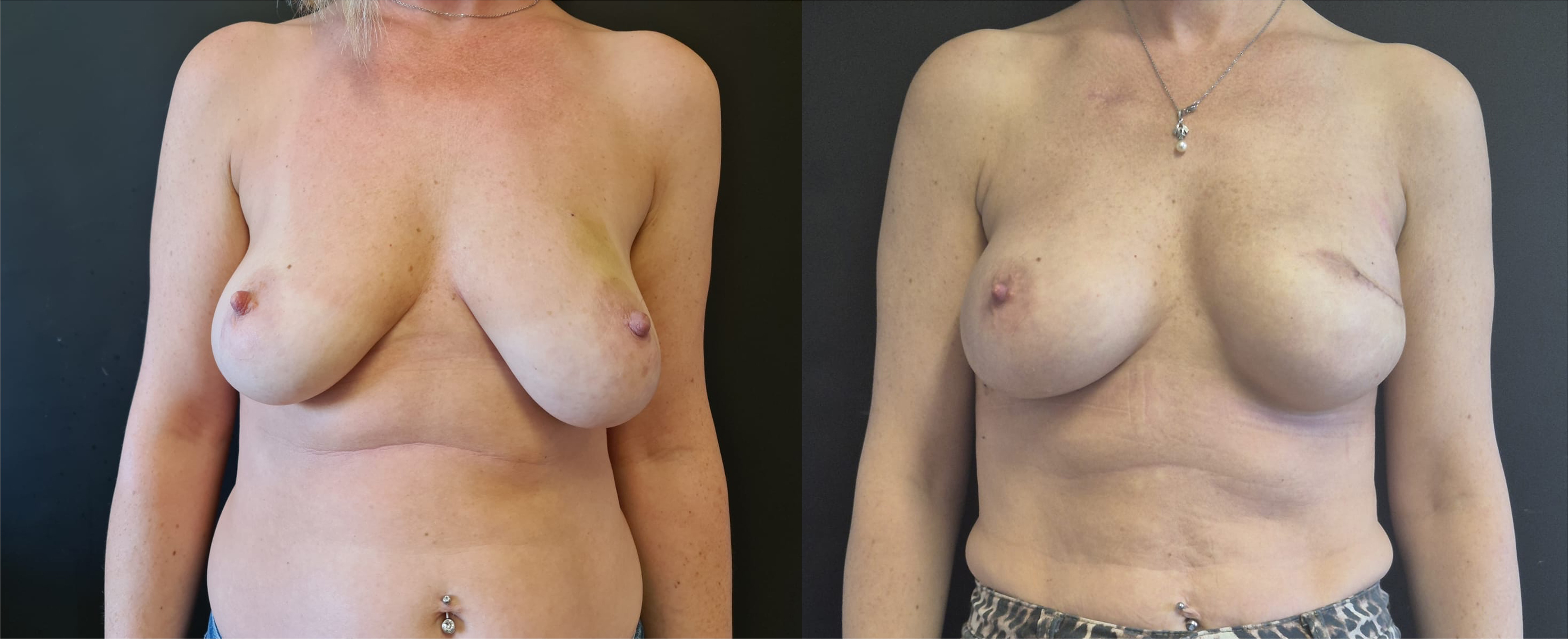 Implant salvage in post-mastectomy reconstruction complicated with infection: molecular diagnosis and negative-pressure wound therapy combined with expander