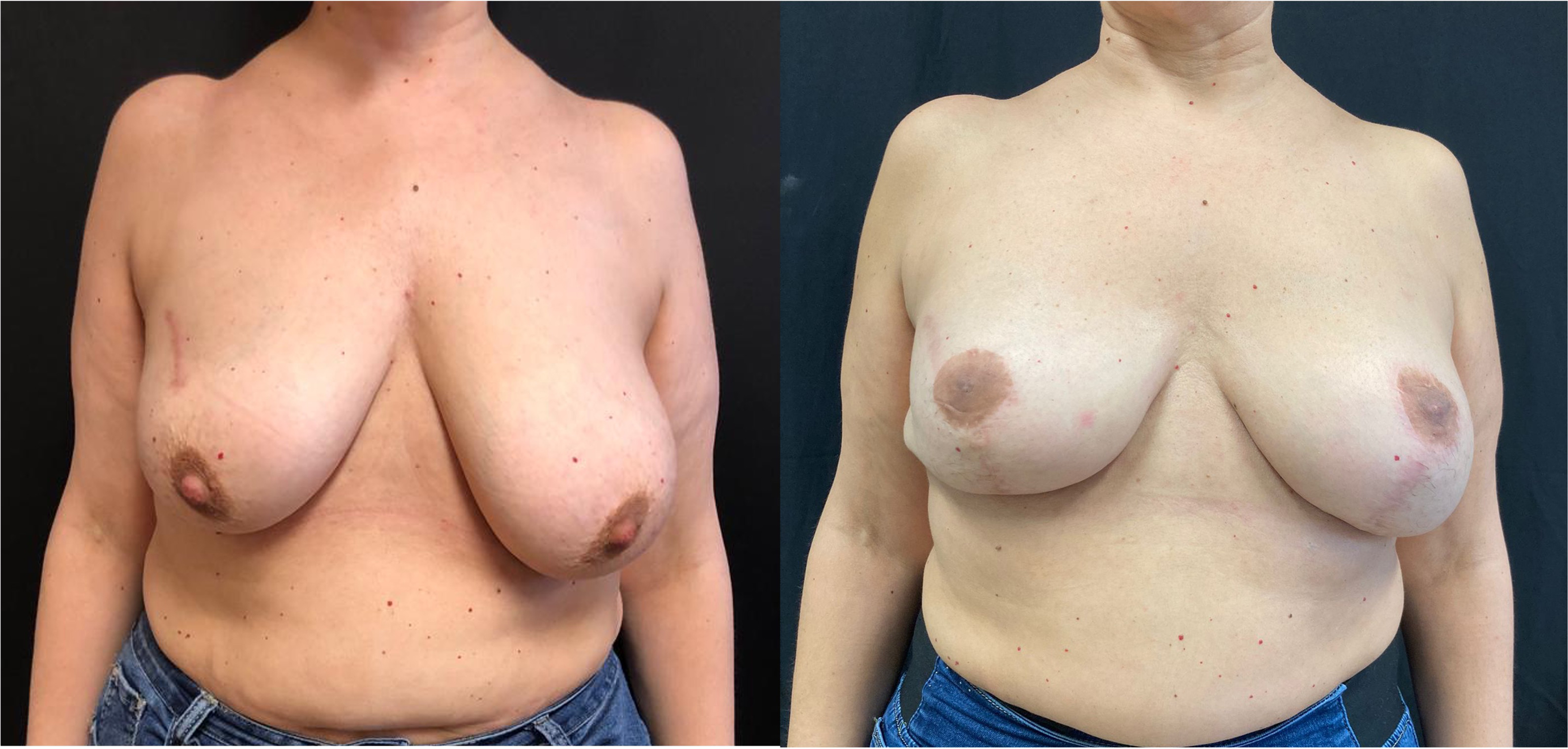 Implant salvage in post-mastectomy reconstruction complicated with infection: molecular diagnosis and negative-pressure wound therapy combined with expander