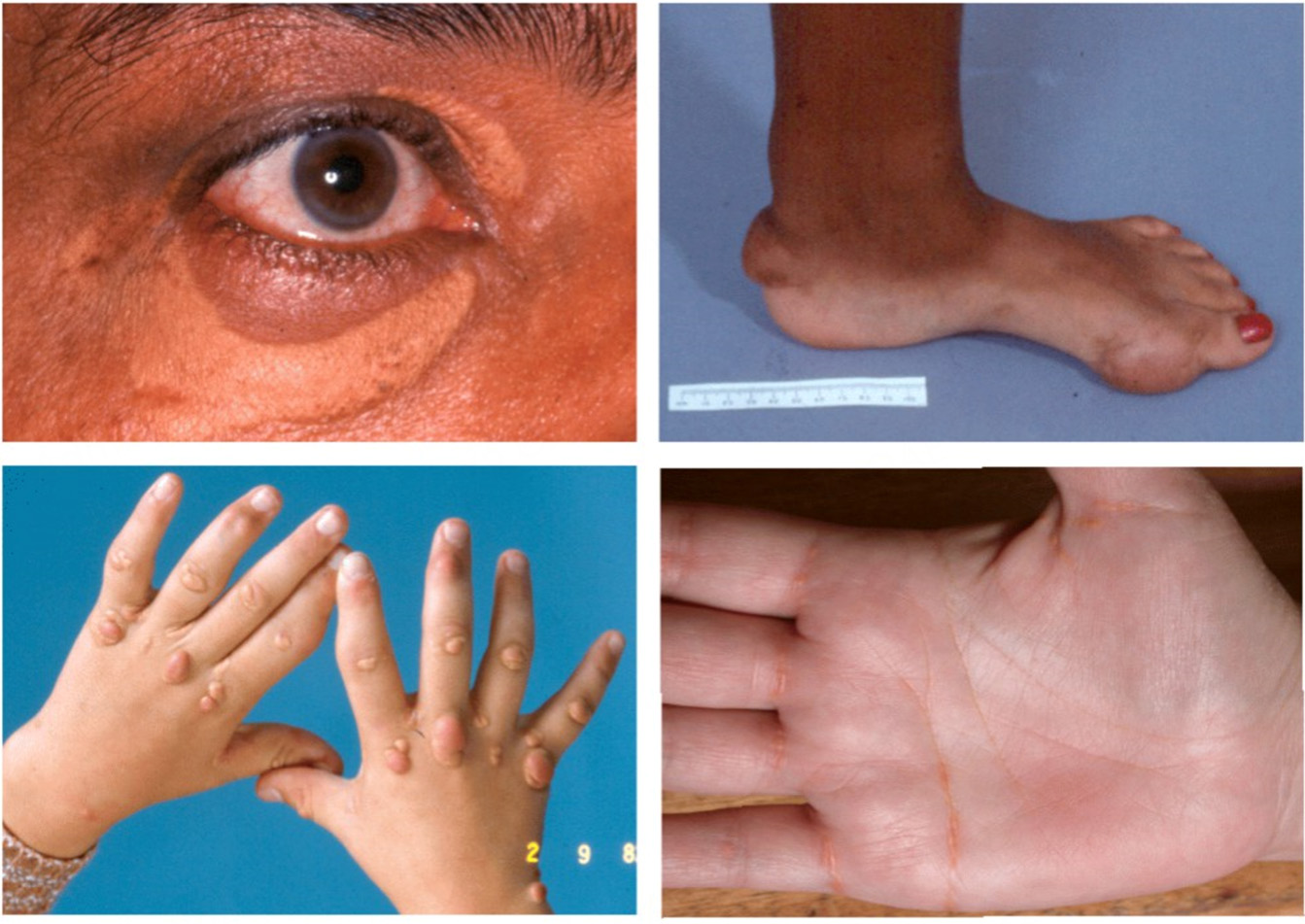 Discriminating dyslipidemias - a South African perspective