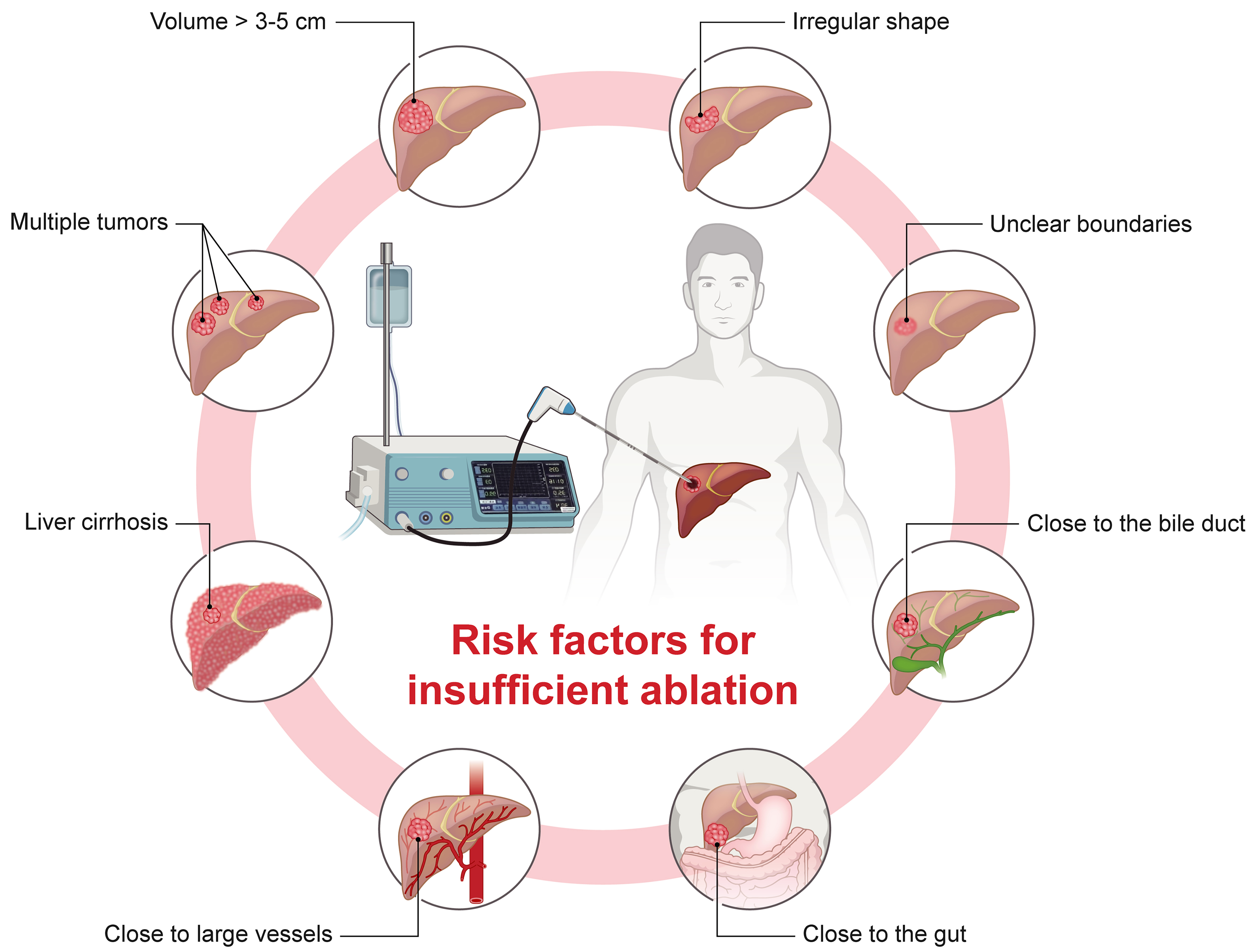 Thermal ablation therapy for hepatocellular carcinoma: recurrence mechanisms and intervention strategies