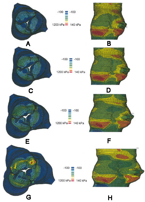 How geometry drives innovation in aortic valve repair