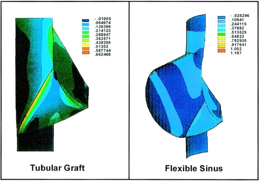 How geometry drives innovation in aortic valve repair