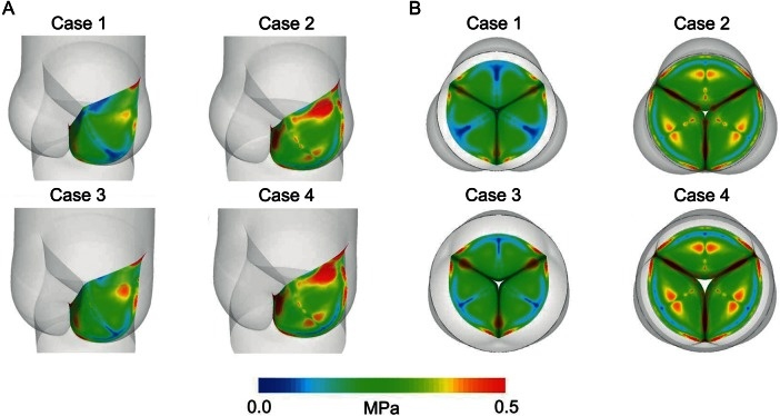 How geometry drives innovation in aortic valve repair