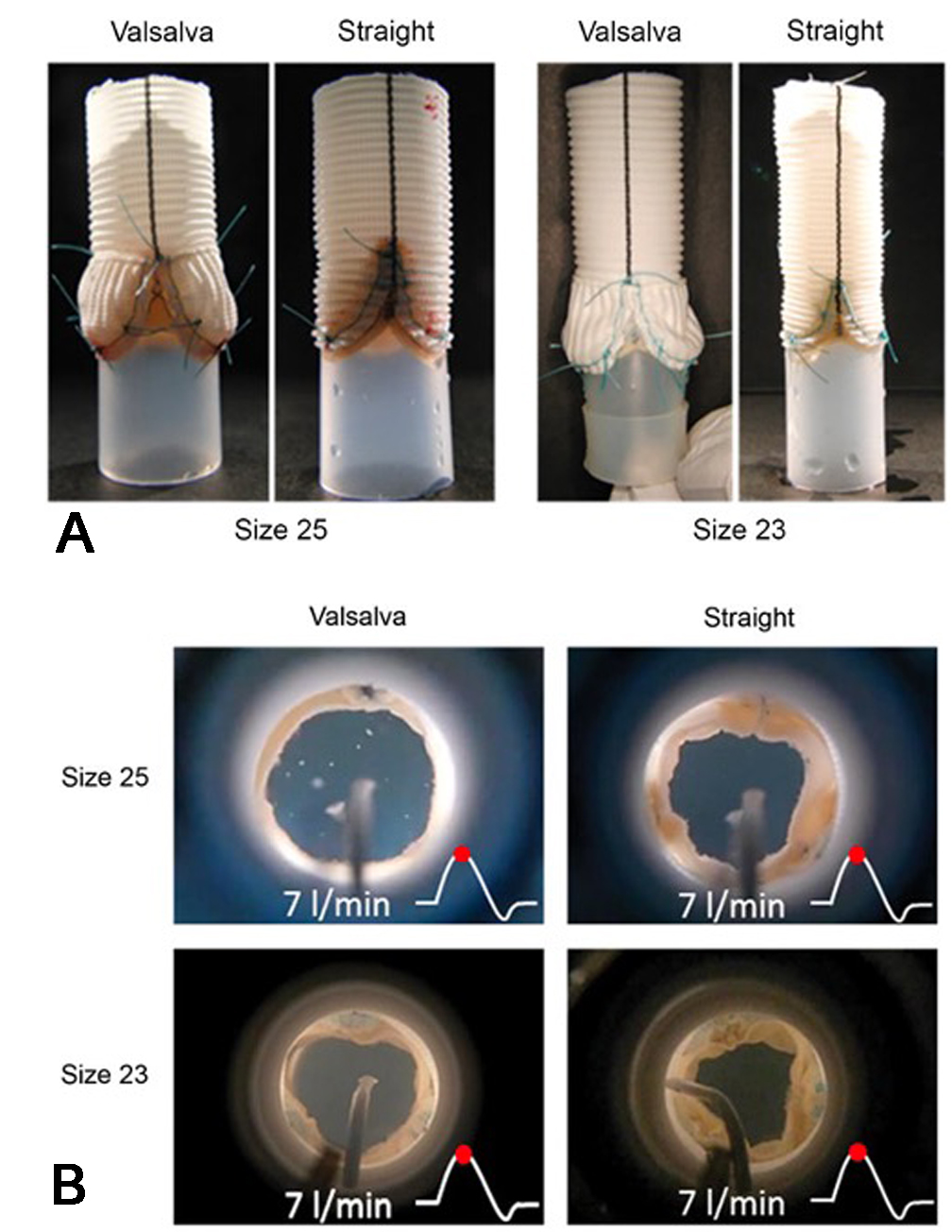 How geometry drives innovation in aortic valve repair