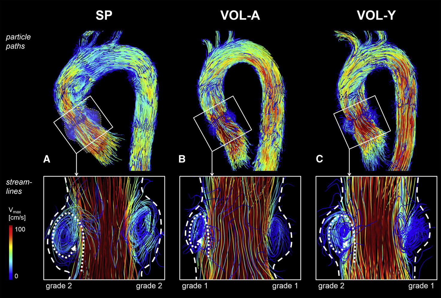 How geometry drives innovation in aortic valve repair