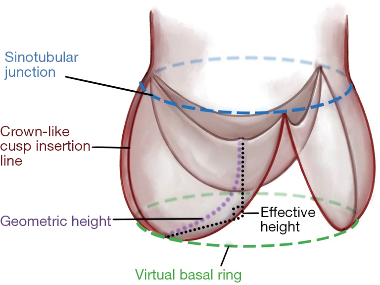 How geometry drives innovation in aortic valve repair