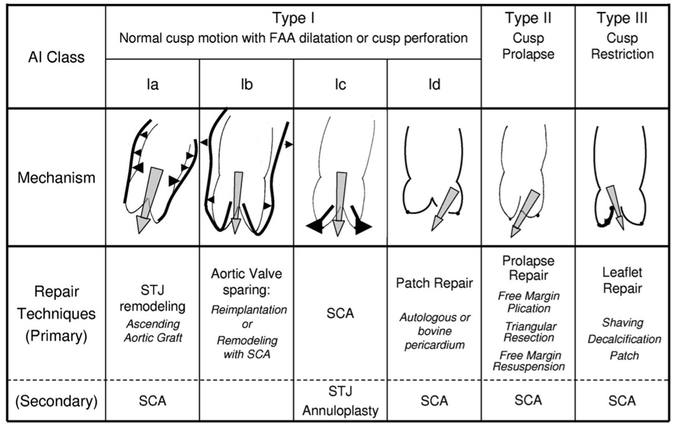How geometry drives innovation in aortic valve repair