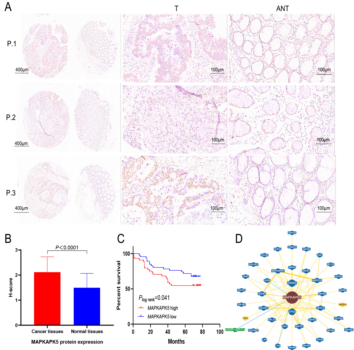 The lnc-MAPKAPK5-AS1 promotes colon cancer-derived liver metastasis via modulating the tumor microenvironment: an <i>in silico</i> study and immunohistochemistry validation