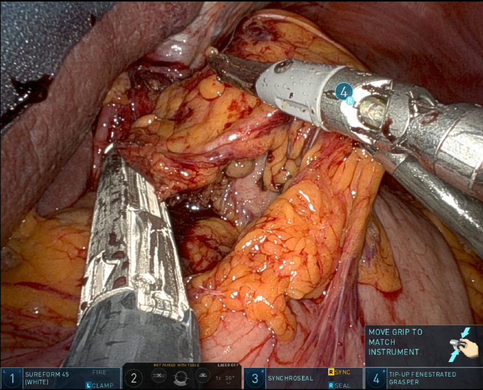 Advances in minimally invasive esophagectomy (MIE): techniques, outcomes, and future directions