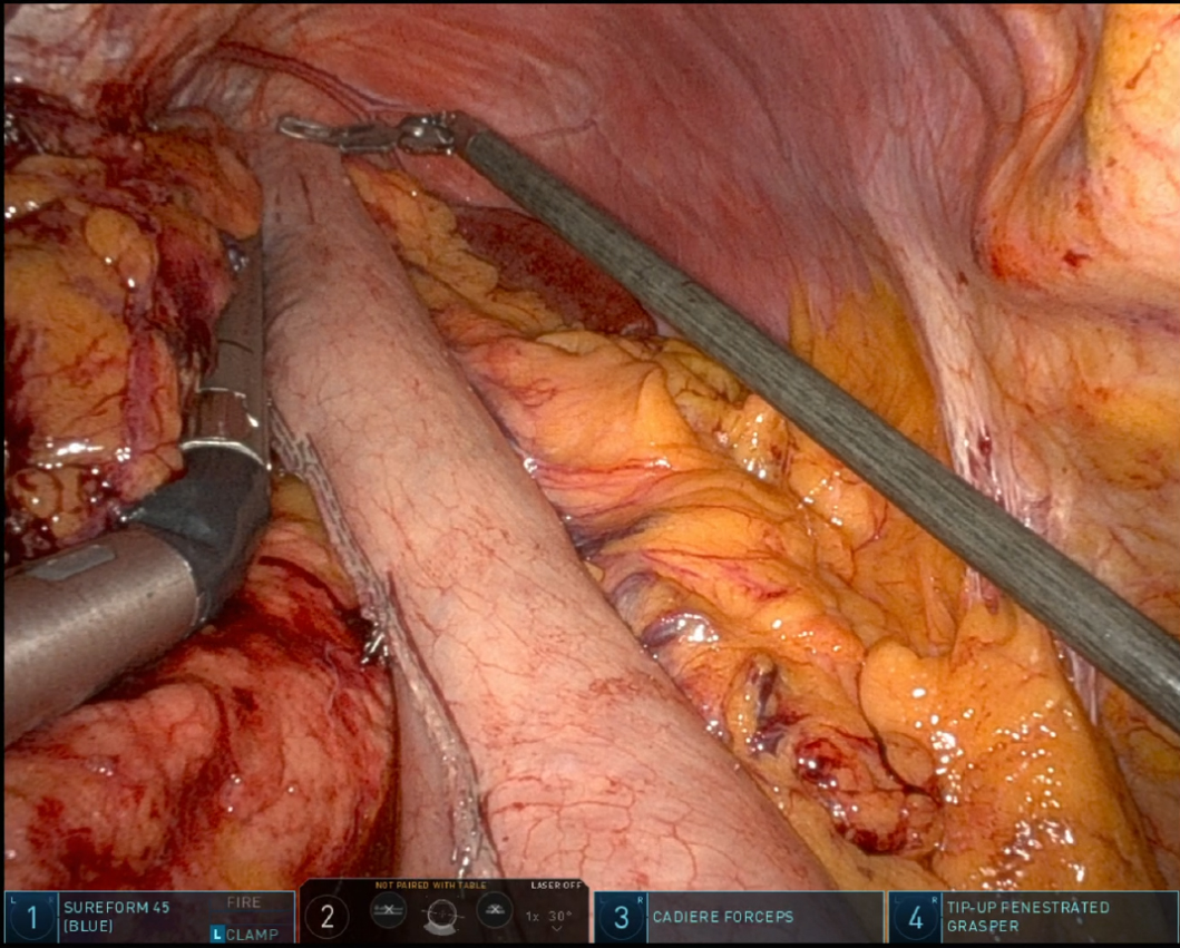 Advances in minimally invasive esophagectomy (MIE): techniques, outcomes, and future directions