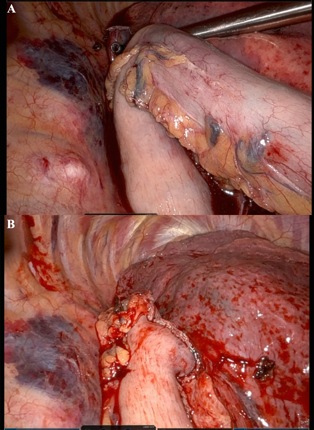 Advances in minimally invasive esophagectomy (MIE): techniques, outcomes, and future directions